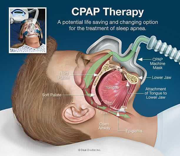 Основы CPAP-терапии
