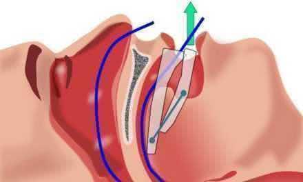 Гиповентиляция / гипоксемия, связанная с обструкцией нижних дыхательных путей